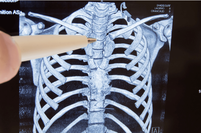 osteocondrose