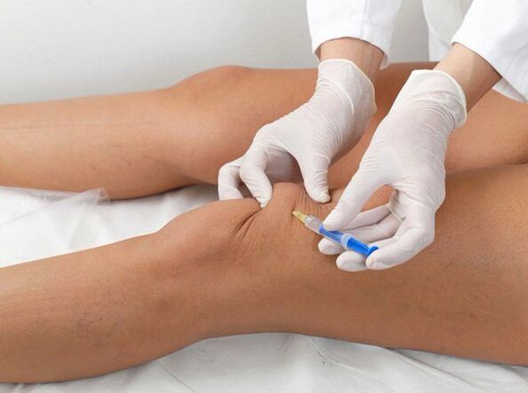 inxección intraarticular para a artrose do xeonllo