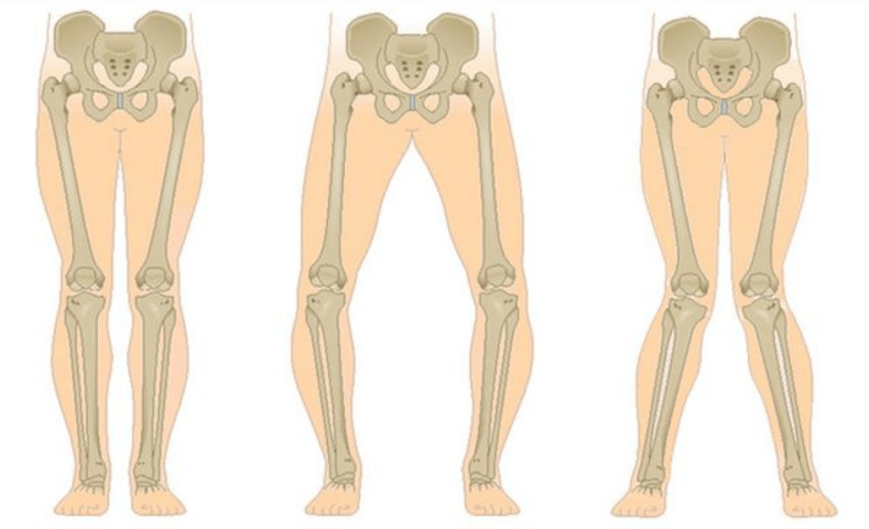 complicacións da artrose do xeonllo
