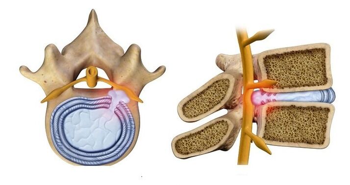 Hernia de disco intervertebral protrusión do núcleo do disco na canle espiñal